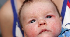 Cách điều trị chàm lác sữa ở mặt cho trẻ sơ sinh