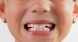 Điều trị tật nghiến răng ở trẻ em