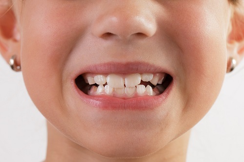 Điều trị tật nghiến răng ở trẻ em