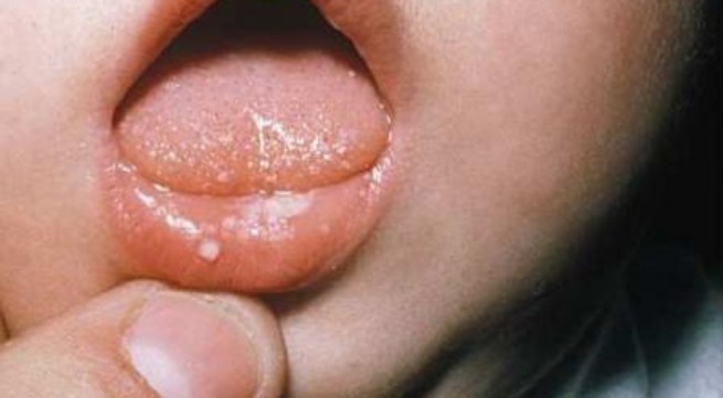 Cách điều trị và phòng ngừa nấm miệng ở trẻ