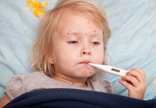 Các triệu chứng của bệnh sởi ở trẻ em
