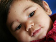 Dấu hiệu và cách phòng chống sốt siêu vi ở trẻ