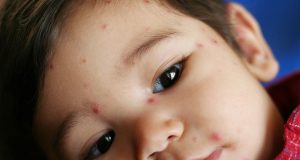 Dấu hiệu và cách phòng chống sốt siêu vi ở trẻ