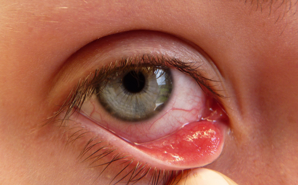 Cách chữa đau mắt đỏ ở trẻ