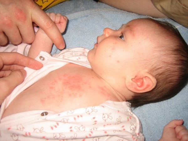 Cách chữa bệnh sốt phát ban ở trẻ