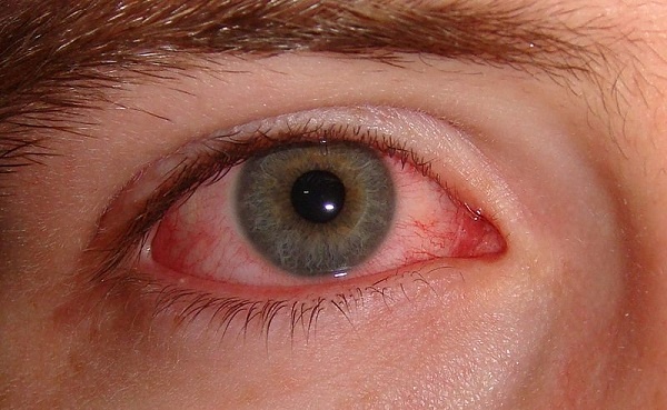  Bệnh về mắt thường hay gặp ở người cao tuổi
