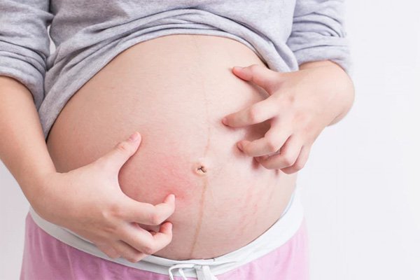 Tìm hiểu hiện tượng ngứa toàn thân khi mang thai và khiến bà bầu có thể sinh non.