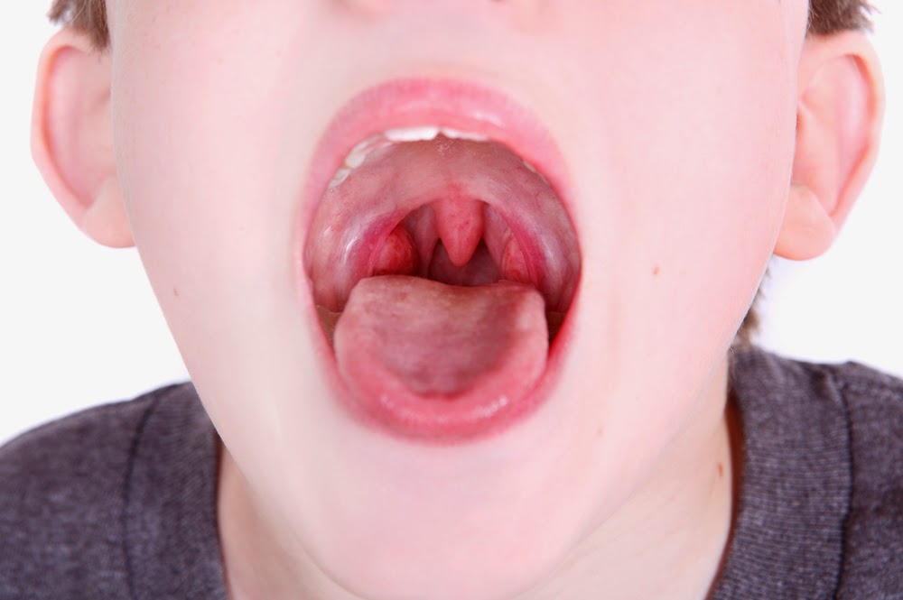 Mức độ nghiêm trọng của bệnh viêm họng
