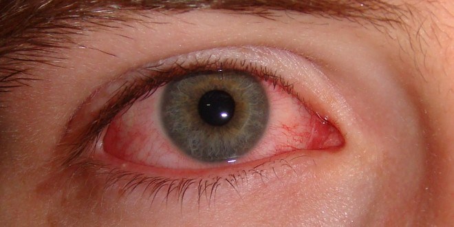Bệnh đau mắt đỏ lây lan qua những con đường nào? Cách khắc phục tốt nhất tình trạng bệnh đau mắt đỏ này. 