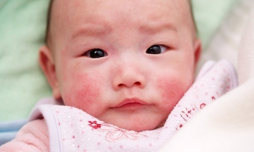 Mẹo hay trị khô da nứt nẻ mặt ở trẻ vào mùa đông cực hiệu quả và an toàn.
