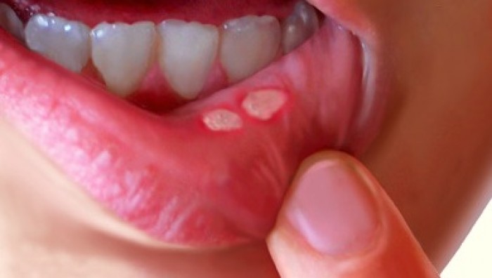 Trẻ bị nhiệt miệng lưỡi và các bài thuốc dân gian hiệu quả và an toàn nhất nhé.