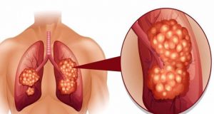 Triệu chứng và dấu hiệu nhận biết ung thư phổi