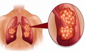  Triệu chứng và dấu hiệu nhận biết ung thư phổi 