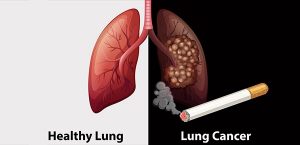 Bệnh ung thư phổi 