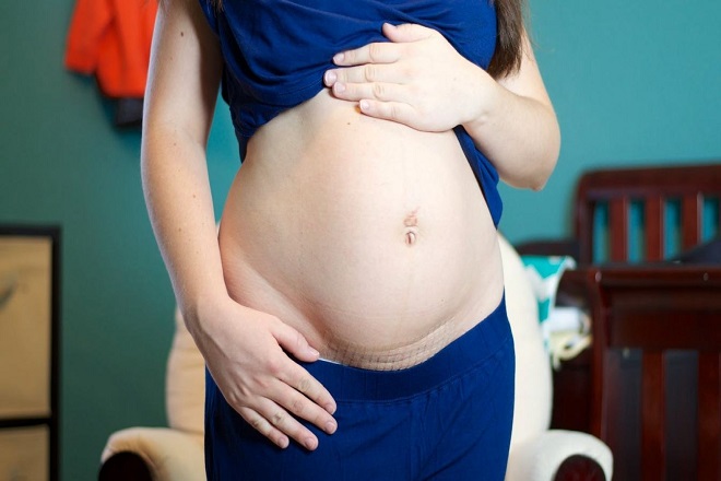 Những điều cần biết để giúp mẹ phục hồi sức khỏe sau sinh mổ