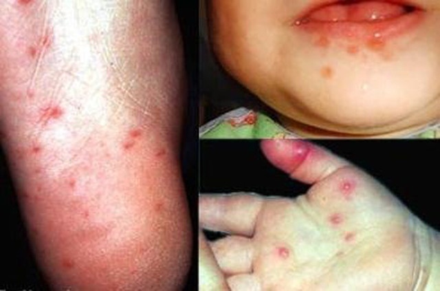 Thông tin về bệnh tay chân miệng ở trẻ em mà các mẹ không thể làm ngơThông tin về bệnh tay chân miệng ở trẻ em mà các mẹ không thể làm ngơ