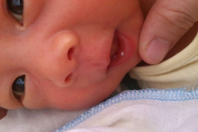 Bệnh cam ở trẻ sơ sinh và những điều cần biết