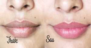 cách trị thâm môi