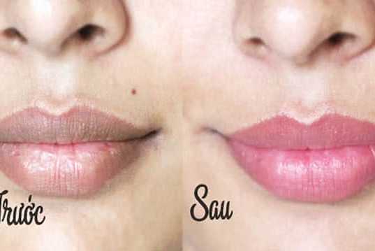 cách trị thâm môi